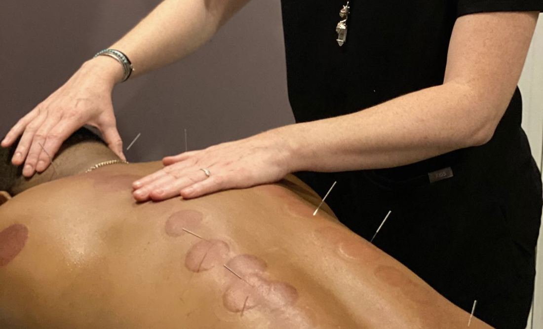 Acupuncture and cupping session on a client's back
